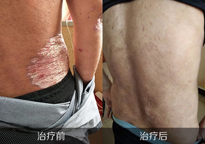 银屑病治疗