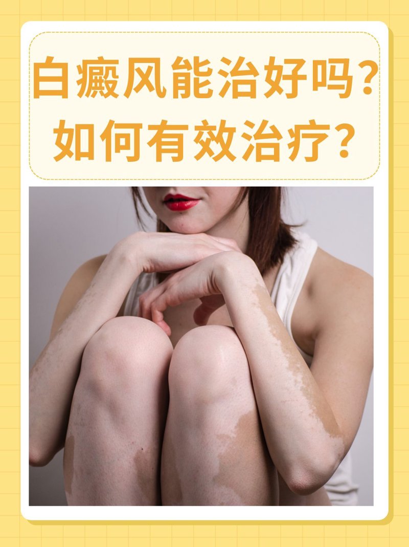 白癜风治疗